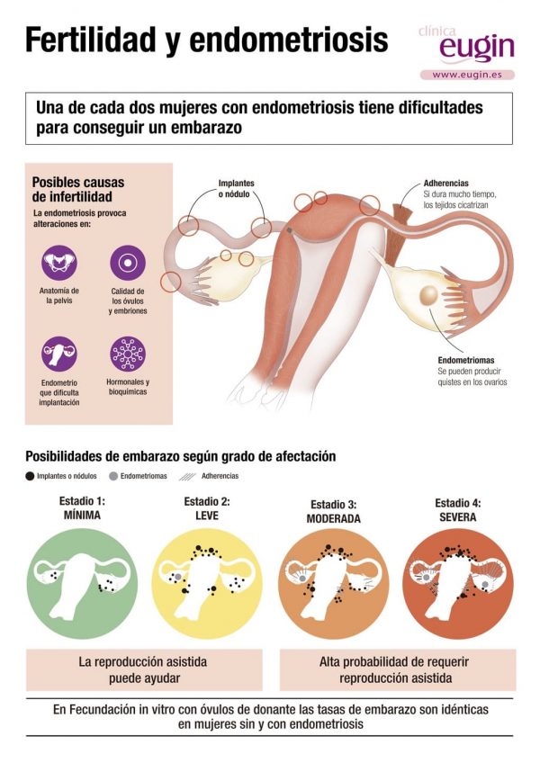 ¿Cómo afecta la endometriosis a tu fertilidad? Eugin